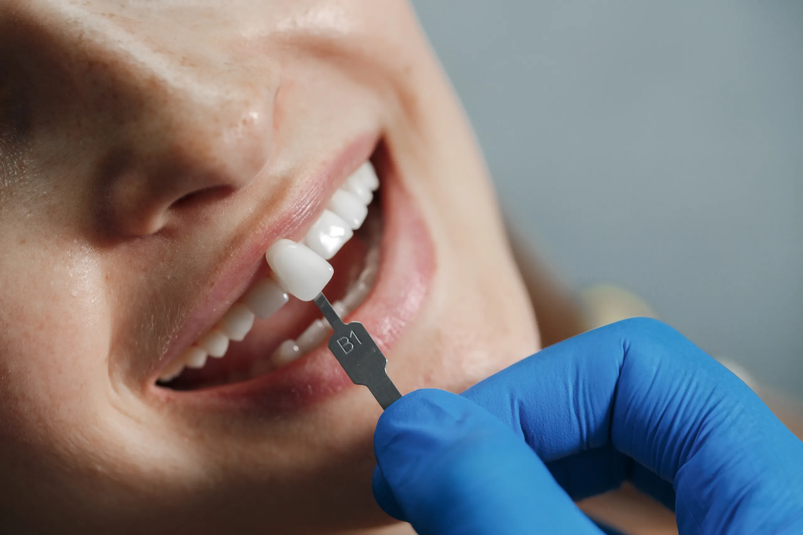 Referencia visual de blanqueamiento dental profesional